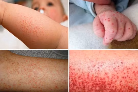 Người mắc sốt xuất huyết tại Hà Nội tăng mạnh