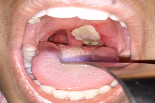 Bộ  Y tế: Cần lấy mẫu xét nghiệm, điều trị kháng sinh dự phòng với người nghi mắc bệnh bạch hầu