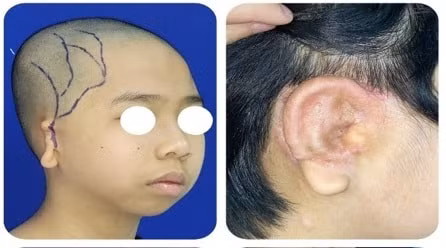 Tái tạo khuôn mặt cho cháu bé trước khi vào lớp 1
