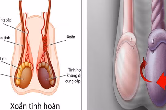 Phú Thọ: Nam thanh niên hỏng "của quý" do đến viện muộn