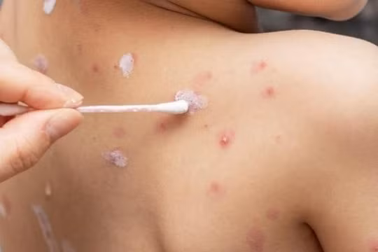 Bị thủy đậu một bệnh nhân 32 tuổi tử vong