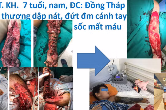 Nát tay vì trẻ vào công trình xây dựng thò tay vào máy trộn bê tông