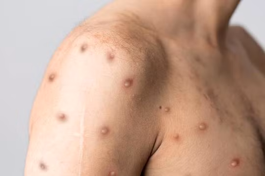 Bộ Y tế yêu cầu xây dựng kịch bản chống dịch Đậu mùa khỉ