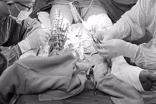 Chân bị đứt lìa, sau một tuần vẫn nối thành công