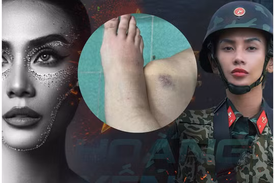 Siêu mẫu Hoàng Yến khiến khán giả lo lắng khi lộ bị thoái hoá khớp