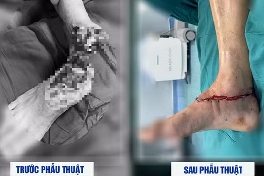 Đi cắt cỏ, người đàn ông bị máy cắt lìa cổ chân phải