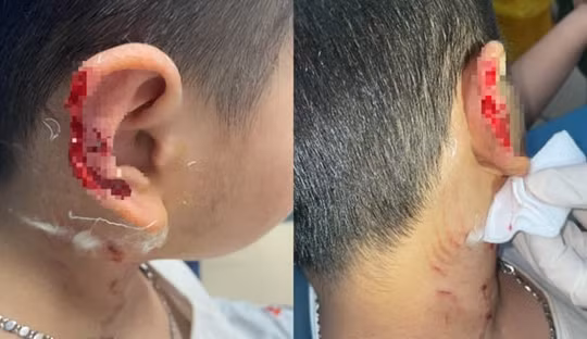 Bị chó lạ Phú Quốc vồ cắn, tai bé trai thương tích biến dạng