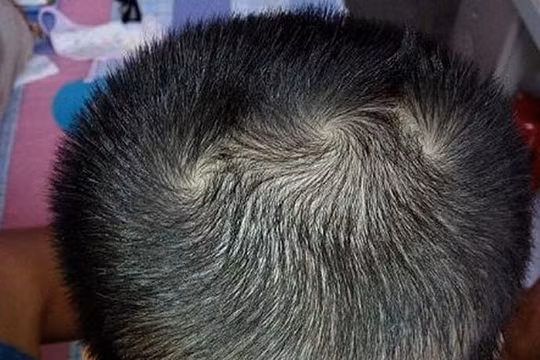 Xem tướng xoáy tóc trên đầu đoán vận mệnh, tính cách