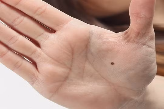 Nốt ruồi trong lòng bàn tay là tốt hay xấu?