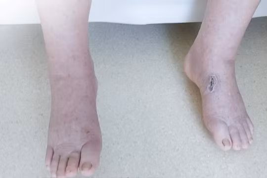 Bị phù chân, khó thở vì sử dụng thực phẩm chức năng “nhập ngoại” có chứa Corticoid