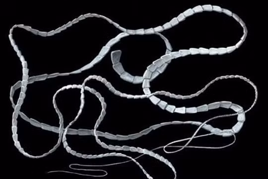 Hà Nội: Phát hiện sán dài 6m trong cơ thể của một cô gái