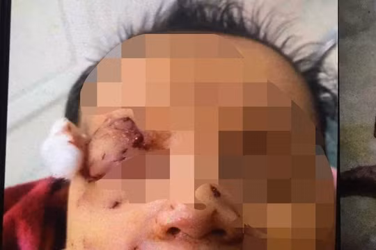 Cháu bé sơ sinh nghi bị chuột cắn vùng mặt