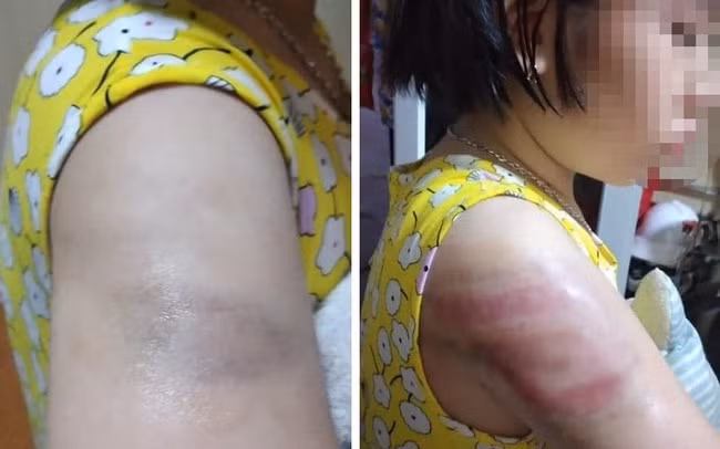 Vết bầm tím trên cánh tay em học sinh. Ảnh: gia đình cung cấp