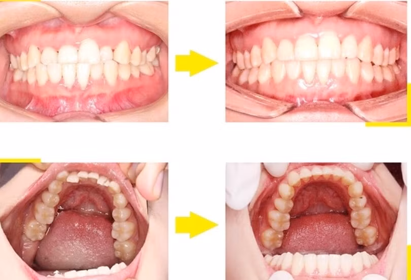 Hiệu quả thấy rõ sau khi niềng răng bằng VinciSmile.
