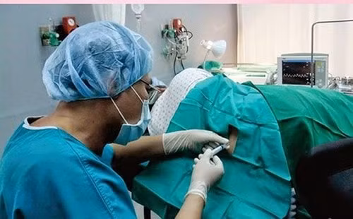 Biện pháp gây mê tủy sống giảm đau trong mổ lấy thai. Ảnh minh họa