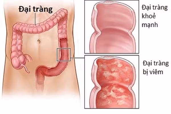 dau hieu nao nguy hiem cua benh dai trang hinh 1