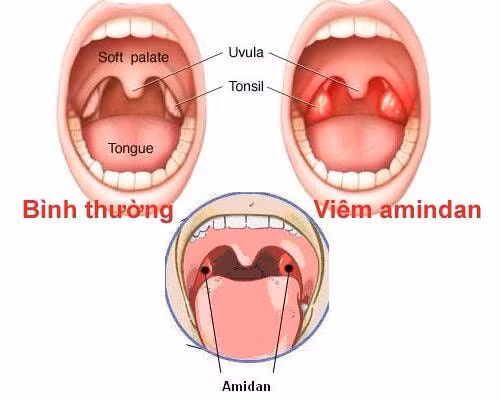 cac trieu chung cua viem amidan va cach xu ly hinh 1
