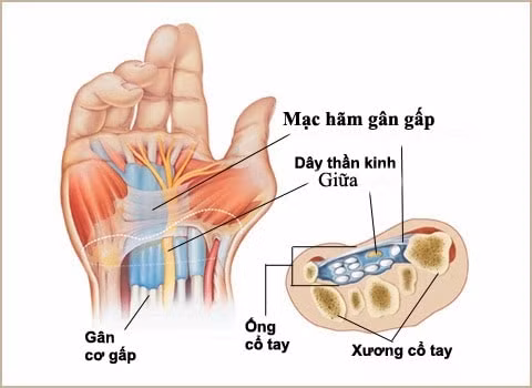trieu chung ong co tay va cach dieu tri hinh 2
