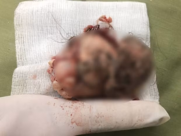 Khối u quái đường kính 8 cm với các cấu trúc mô cơ thể như răng, xương hàm, tóc, da đầu (Ảnh: BVCC)