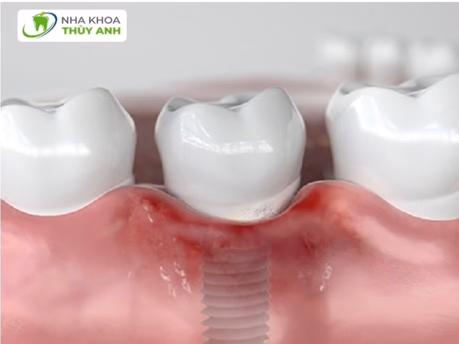 trong rang implant gia re thu pham tan pha suc khoe rang mieng hinh 1