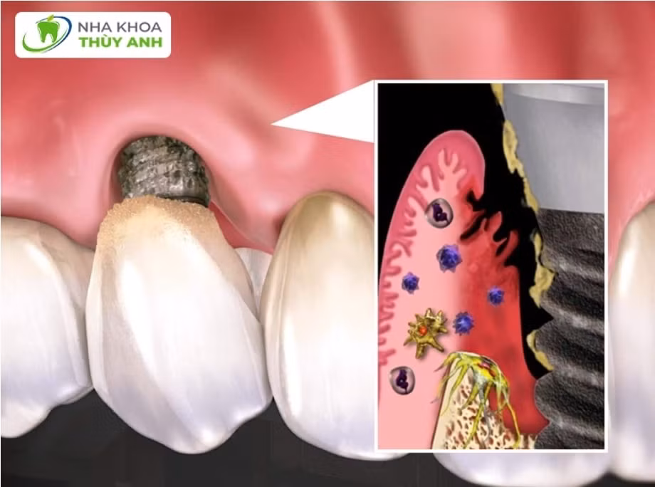 trong rang implant gia re thu pham tan pha suc khoe rang mieng hinh 2