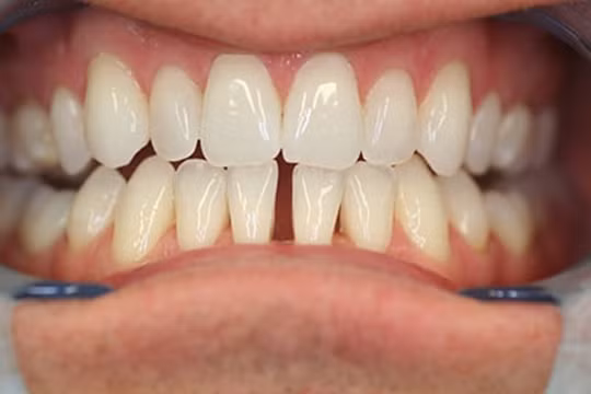 Những tướng răng vất vả, thị phi đeo bám