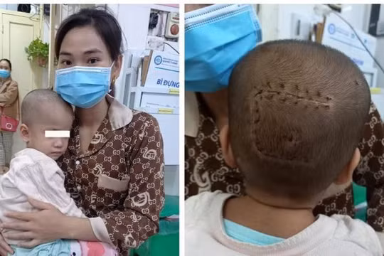 5 giờ phẫu thuật căng thẳng lấy khối u màng não ở vị trí hiểm cứu bé 2 tuổi