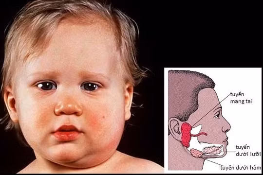 Những lưu ý nhằm phòng biến chứng của bệnh quai bị ở trẻ nhỏ