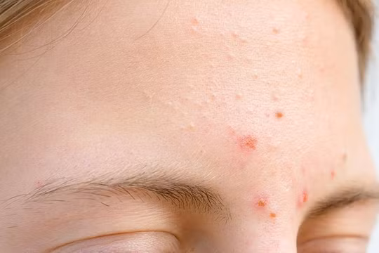 5 dấu hiệu lạ trên gương mặt là điềm báo phá tài