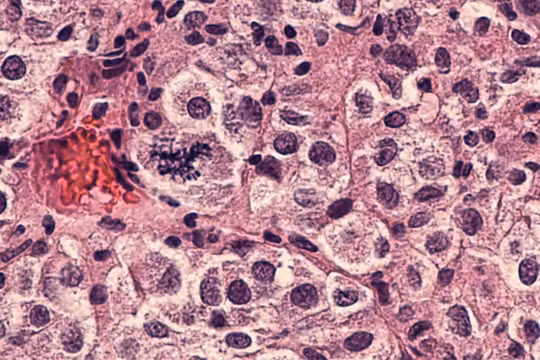 Vắc xin ung thư cá nhân hóa mRNA hứa hẹn nhiều đột phá