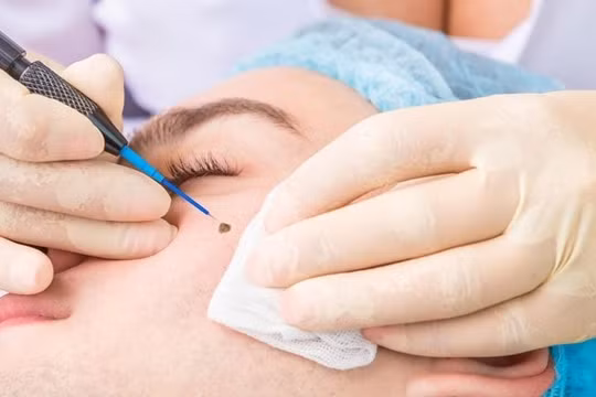 Hậu quả nguy hiểm khi tẩy nốt ruồi sai cách