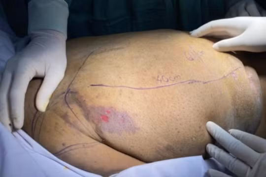 Mang “mai rùa” 2,6 kg, người phụ nữ khổ sở vì căn bệnh lạ