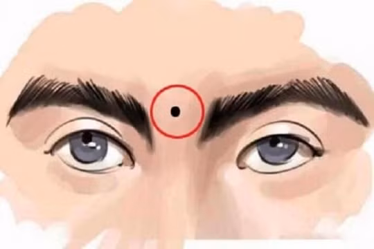 5 nốt ruồi tài lộc cực hiếm người sở hữu