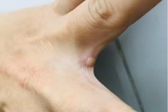 TP. HCM có ca đậu mùa khỉ thứ 2