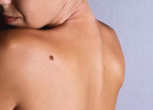Ý nghĩa nốt ruồi sau lưng phụ nữ