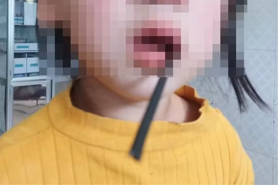 Té ngã trong lúc chạy chơi, bé gái 4 tuổi bị thanh sắt đâm xuyên miệng