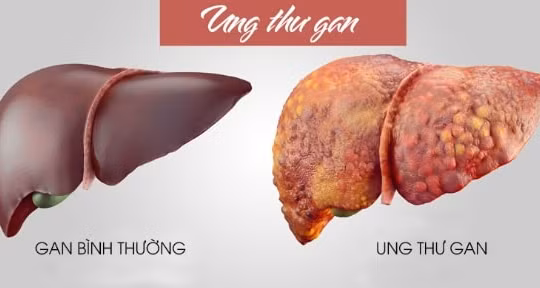 Ung thư gan điều trị bằng hóa chất hiệu quả thấp