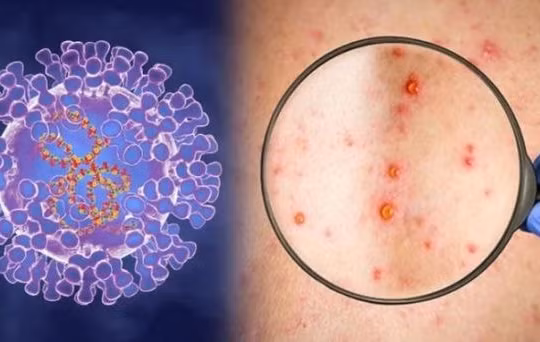 Chủ động kiểm soát, tăng cường công tác phòng, chống bệnh đậu mùa khỉ