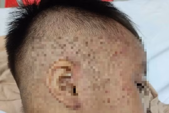 Cấp cứu kịp thời bé trai 3 tuổi rưỡi nghi bị bạo hành nhốt trong tủ cấp đông