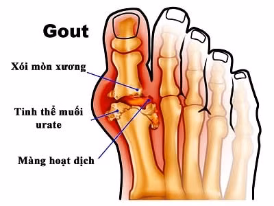 Những dấu hiệu đầu tiên và đặc trưng của bệnh gout
