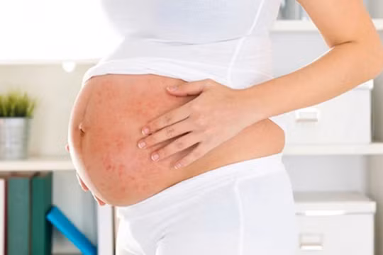 Mắc sởi khi mang bầu, nguy hiểm đối với cả mẹ và con