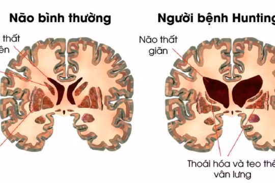 Lần đầu tiên điều trị thành công bệnh di truyền múa giật Huntington
