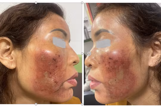 Hàng loạt trường hợp cầu cứu vì peel da không đúng cách