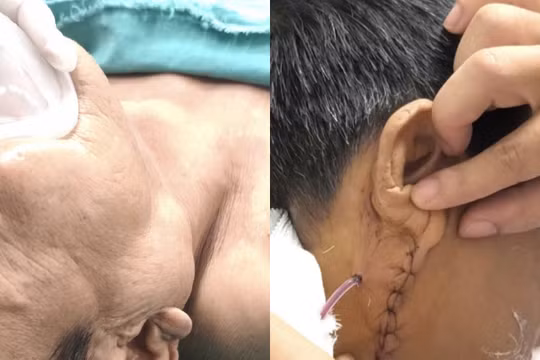 Bệnh nhân 70 tuổi tái phát u tuyến nước bọt sau 10 năm, suýt liệt mặt