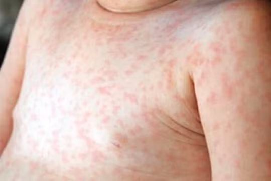 Quảng Nam: Phần lớn các ca mắc sởi chưa được tiêm vắc xin
