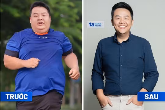Thoát “bụng bia” nhờ giảm cân chuẩn y khoa