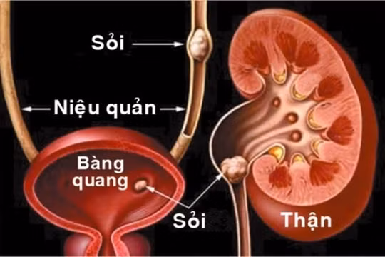 Chuyên gia bật mí: Phòng ngừa và điều trị kịp thời về sỏi tiết niệu