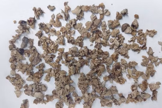 Phẫu thuật thành công ca sỏi thận san hô phức tạp sau 10 năm bệnh nhân tự điều trị bằng thuốc nam