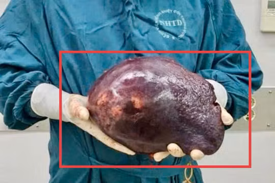 Phẫu thuật thành công khối u chiếm 70% gan, nặng hơn 2,5kg