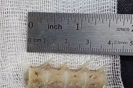 Xương cá dài 4cm găm chặt cổ họng cụ ông 99 tuổi